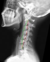 Image of xray of cervical spine